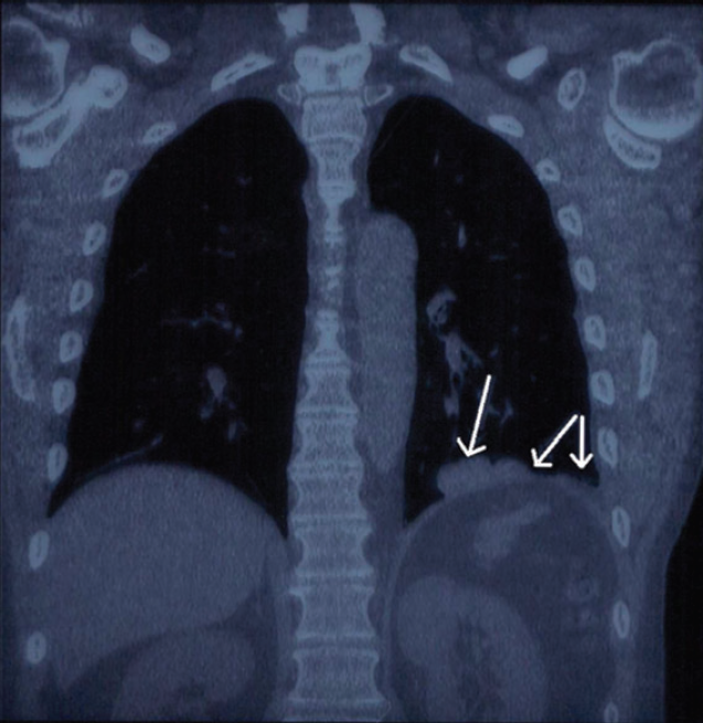 病例：腹部外伤后胸部脾组织异位植入2.png.png